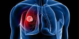 Час перевіритись на туберкульоз